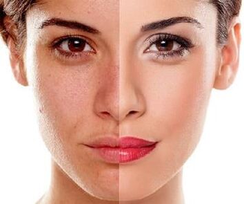 changes in facial skin after laser peel