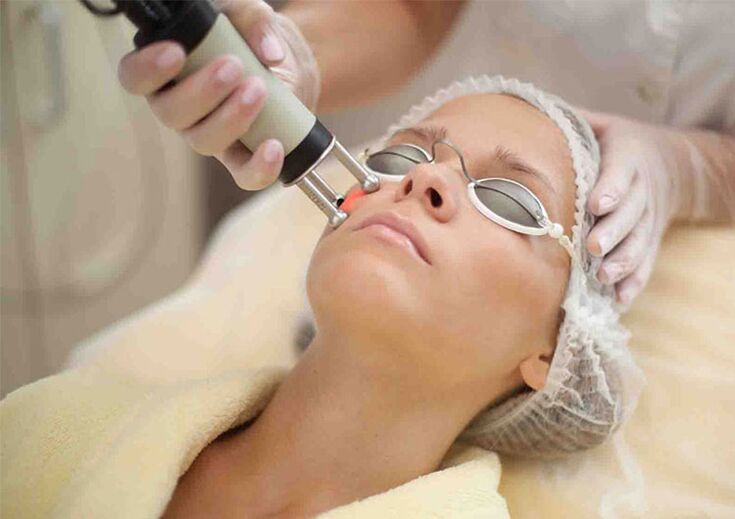 Laser skin resurfacing procedure around the eyes