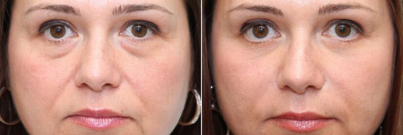 Before and after blepharoplasty removal of the fat body under the eyes and skin tightening
