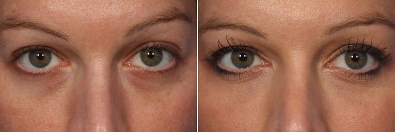 Before and after the use of injectable fillers - reduction of dark circles